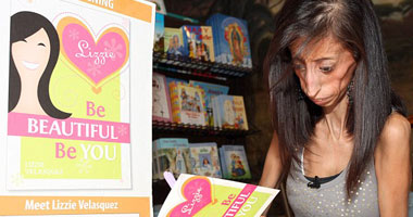 بالصور.. أنحف فتاة فى العالم.. تأكل كل 20 دقيقة لتبقى على قيد الحياة s11201311121914