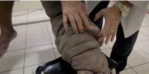 بالصور.. بعوضة تحول برازيلياً إلى فيل رجل